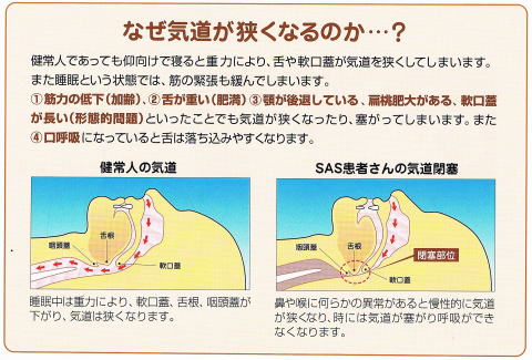 睡眠時無呼吸症（SAS）における気道閉塞のメカニズム