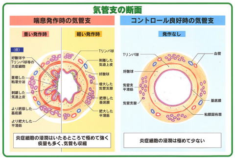 正常の気管支と喘息患者の気管支のイメージ